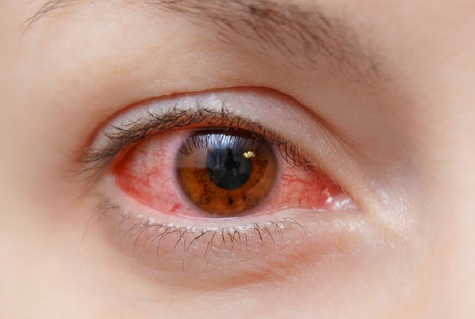 Spread of conjunctivitis across the country