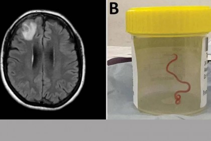 Live worm found in Australian woman's brain