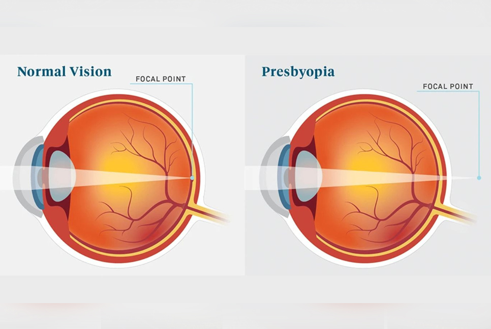 One in five Bangladeshis over 35 have presbyopia