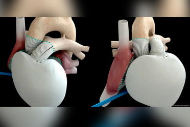 How close are we to the dream of an artificial heart?