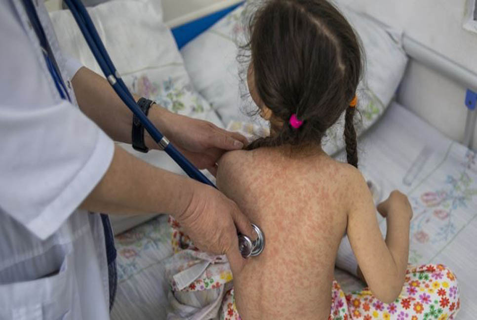 Measles cases surge worldwide, infecting 10.3 million people