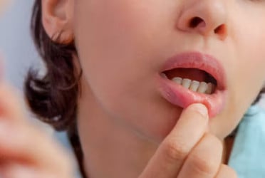 Easy ways to prevent mouth ulcers