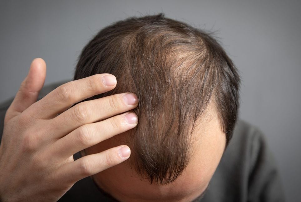 Can social media worsen hair loss?