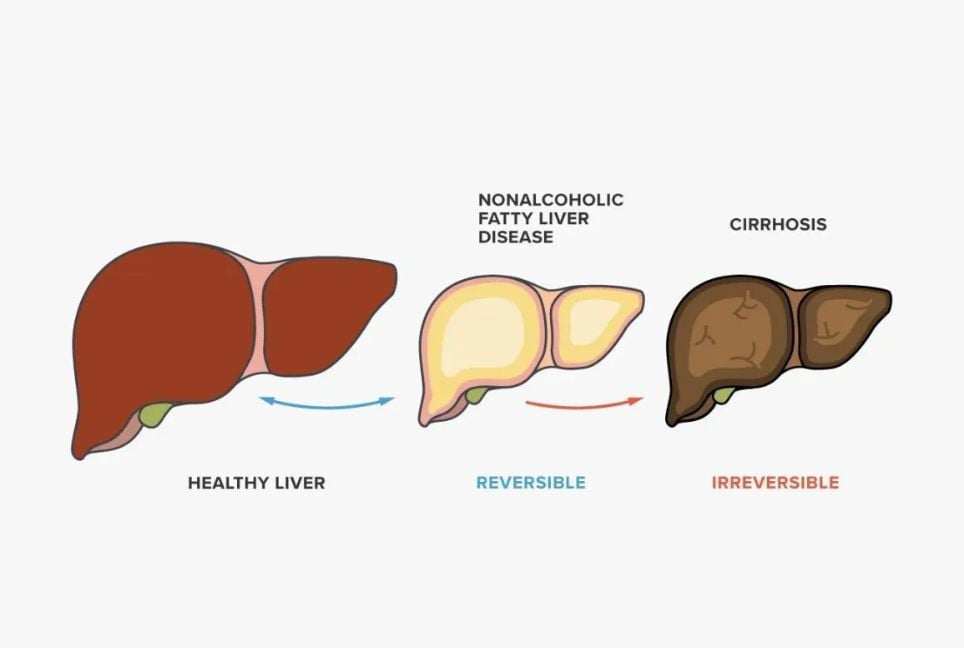 Ways to reverse fatty liver