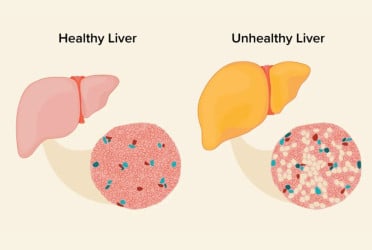 How to detect Fatty liver disease without symptoms