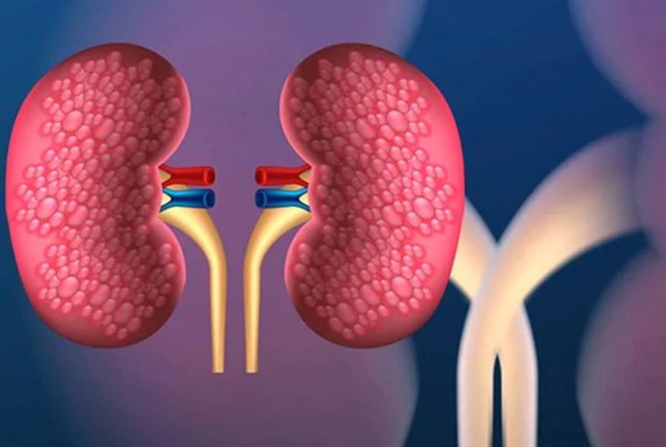 Uncontrolled diabetes, hypertension responsible for kidney disease ...