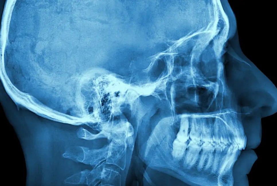 Medical imaging radiation may account for 5% of US cancers