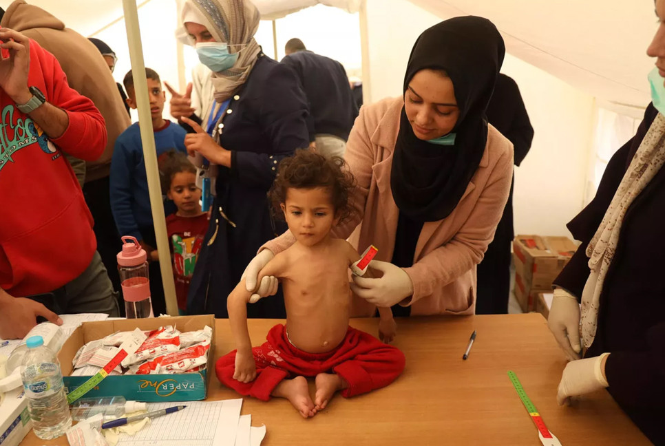 Over 65,000 children hospitalized in Gaza due to acute malnutrition