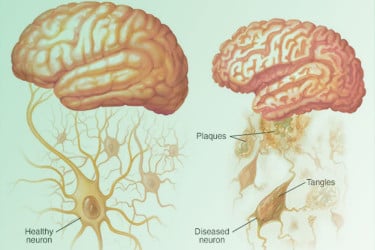People living with Alzheimer’s in America surpasses 7 million, most want early treatment