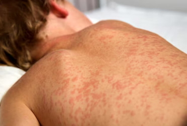 Canada sees sharp rise in measles cases