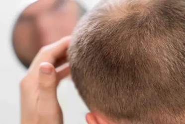 Male baldness: Mother’s genes only partly to blame