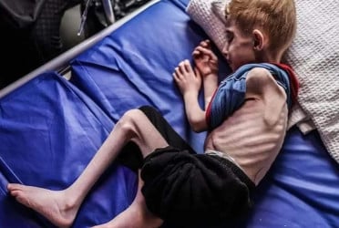 Gaza’s main hospital is overwhelmed with children in pain from malnutrition