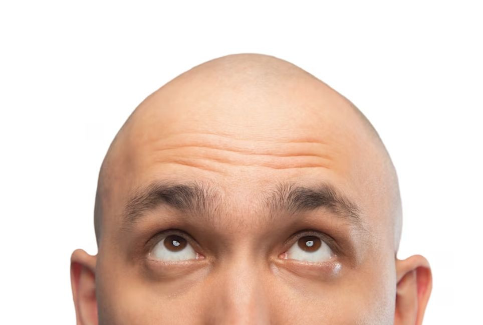 How to reverse hair loss in men