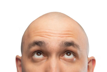 How to reverse hair loss in men