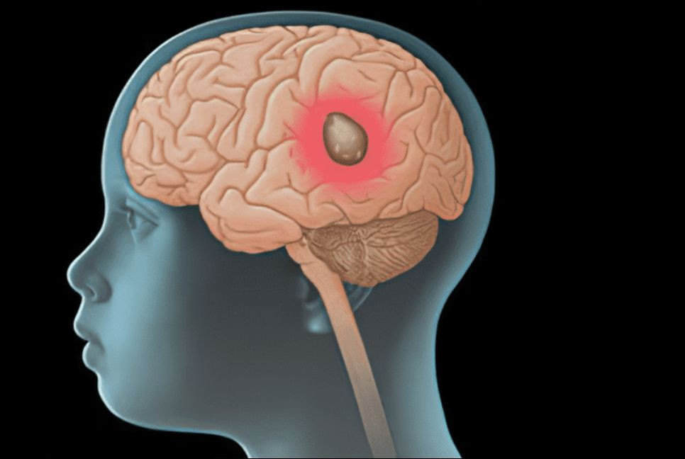 Early detection key to saving lives as brain tumour cases rise among children: Experts