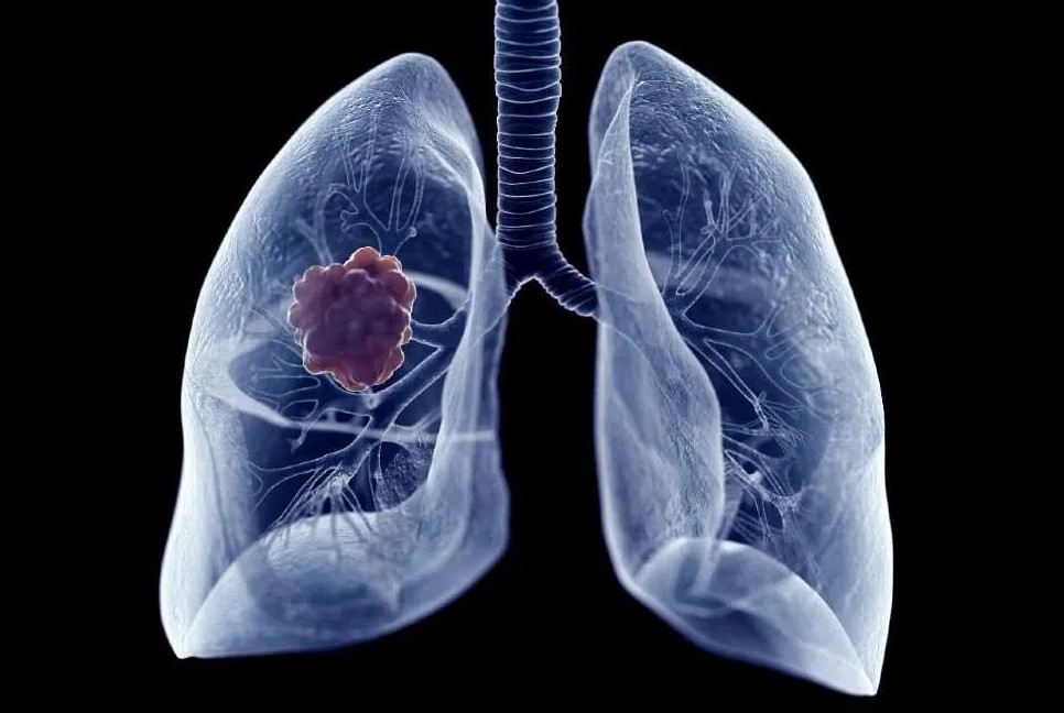 US approves AstraZeneca, Daiichi's treatment for lung cancer