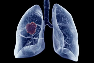 US approves AstraZeneca, Daiichi's treatment for lung cancer