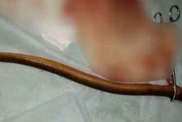 Man found with live eel in abdomen