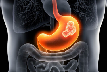 Treatment unveiled to prevent 75 percent of stomach cancer cases: Study