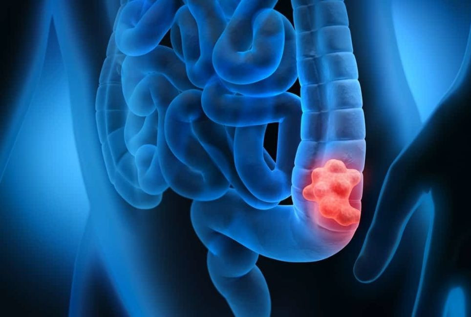 Bloating to night sweats: 4 warning signs of bowel cancer