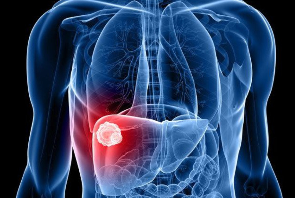 Liver cancer to double worldwide, most of it preventable: Study