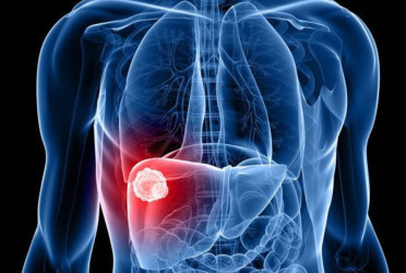 Liver cancer to double worldwide, most of it preventable: Study