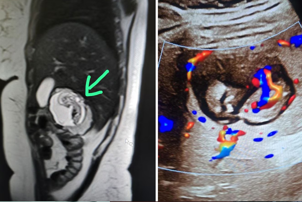 Pregnancy in liver? How a women in India’s UP shocked after went for an MRI