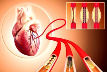 Govt cuts prices of coronary stents by up to Tk50,000