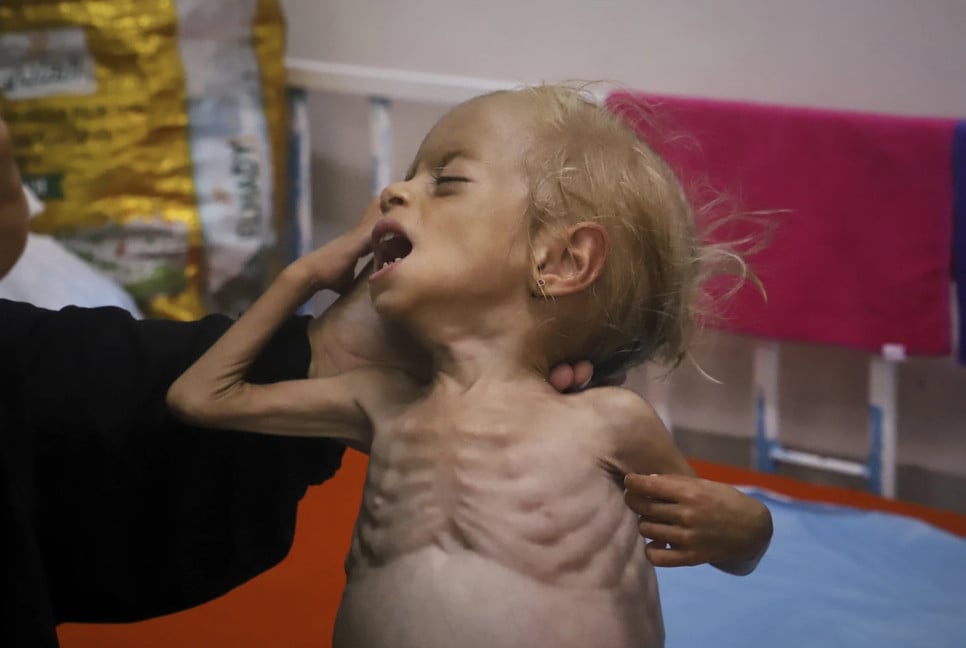 Malnourished kids arrive daily at a Gaza hospital