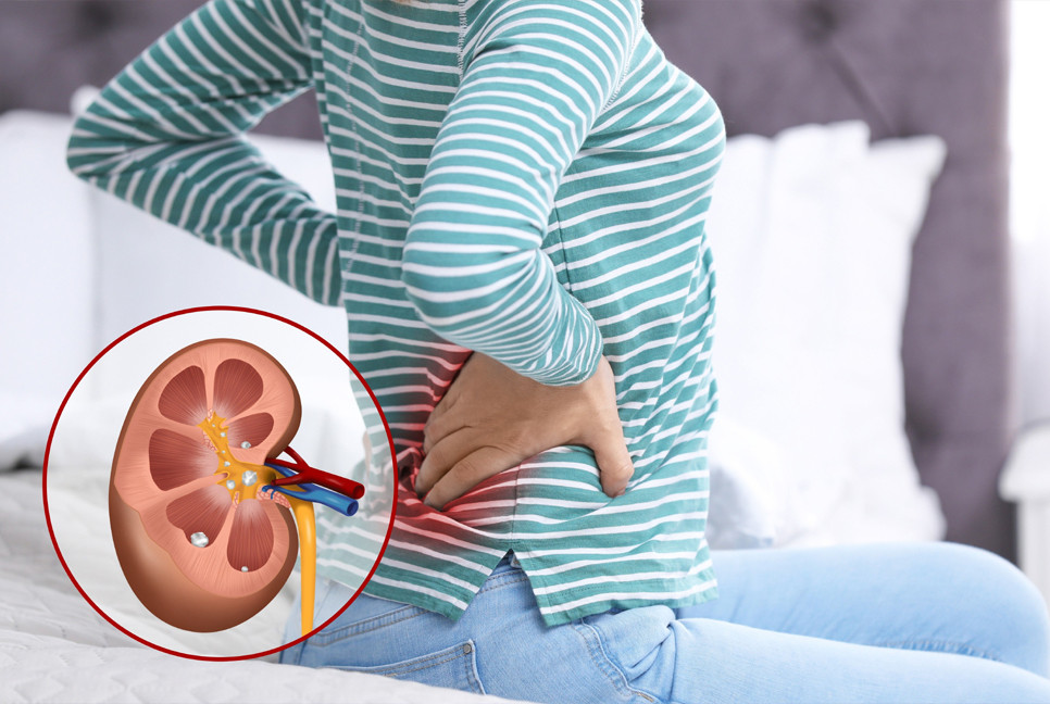 7 tips for kidney stones before they develop: What are oxalate-dense foods?