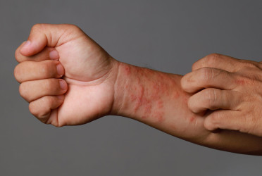 Spotting skin cancer: ABCDE rule and warning signs you shouldn't ignore