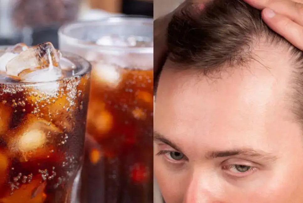 Sugary drinks linked to increased hair loss: Study