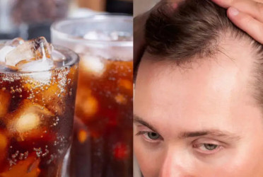 Sugary drinks linked to increased hair loss: Study