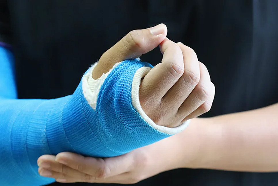 Chinese researchers create 3-minute bone glue for fracture repair