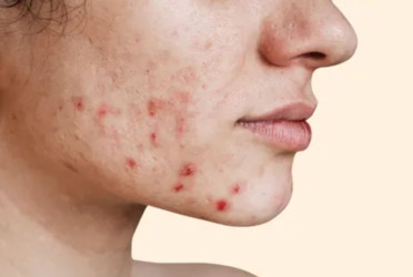 Top three foods to avoid if you have acne
