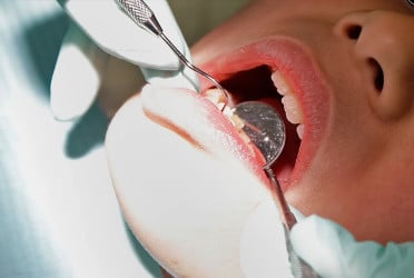 Countries agree to end mercury tooth fillings by 2034