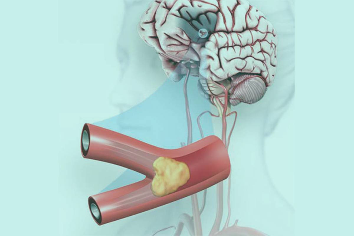 80% of strokes preventable thru lifestyle changes: Experts