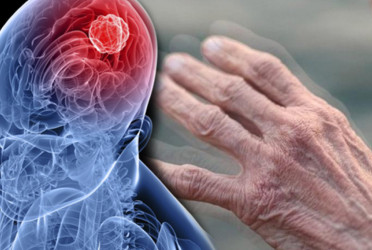 Stiffness,slowed movements may signal Parkinson’s, not just ageing