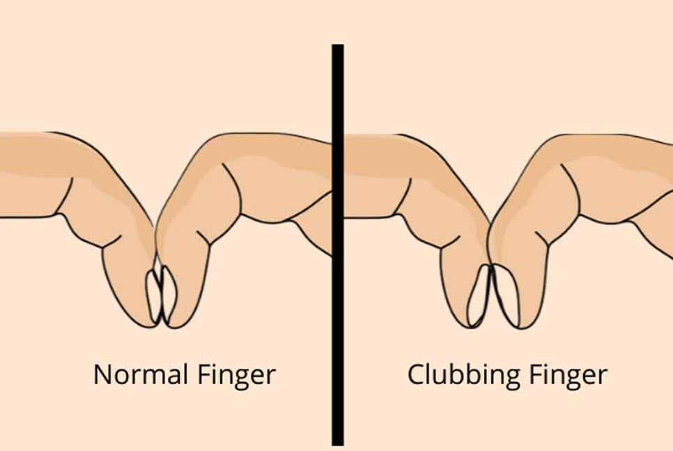 Simple finger test may detect early lung cancer