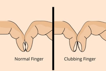 Simple finger test may detect early lung cancer