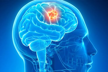 7 brain tumor symptoms you should not ignore