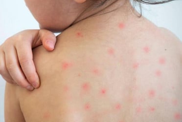 3 more children die from measles, 2 from symptoms