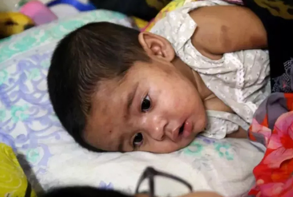 Measles: Death toll climbs to 555 with 10 more deaths in 24 hrs
