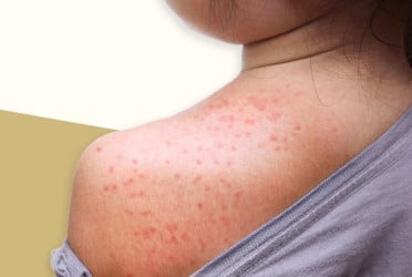 Measles death toll reaches 680 as 3 more die in 24 hrs